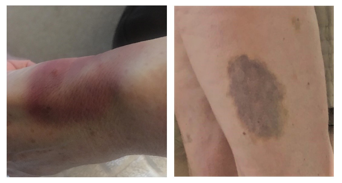 Menopausal Bruising